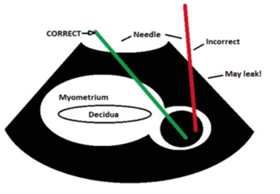 Hình 11.4 Kỹ thuật tiêm MTX vào trong khối thai điều trị thai kẽ. Needle: Kim, Correct/Incorrect: Hướng kim đúng/sai. Myometrium: cơ tử cung, decidua: màng rụng.