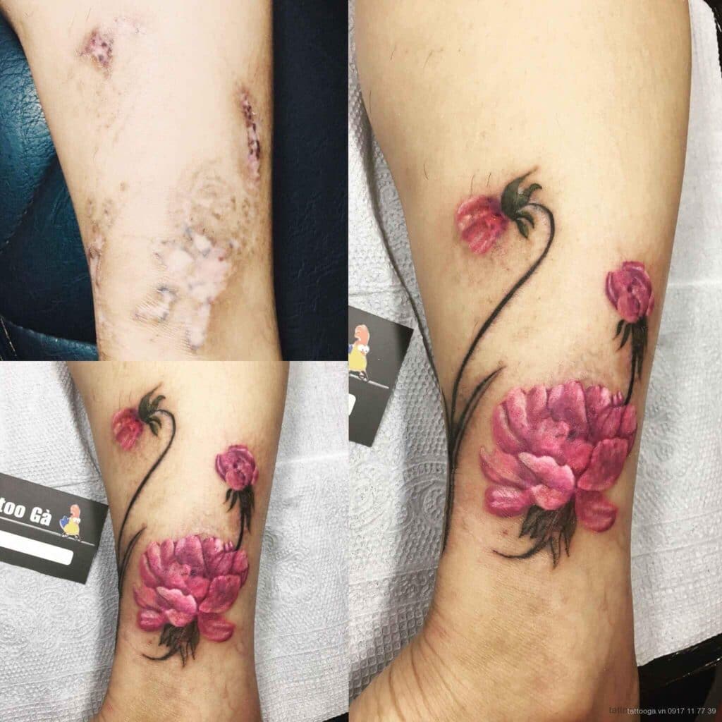 Sẹo phỏng được biến mất hoàn toàn nhờ tattoo hoa đẹp